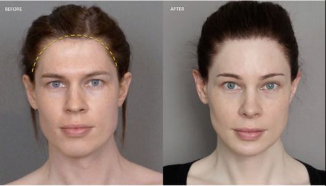 Hairline feminization: seeking perfection in feminizing the forehead region | Facialteam Forehead Reduction Surgery, Jaw Reduction Surgery, Forehead Reduction, Lipo Before And After, Plastic Surgery Fail, Face Surgery, Plastic Surgery Gone Wrong, Cheek Fillers, Scalp Micropigmentation