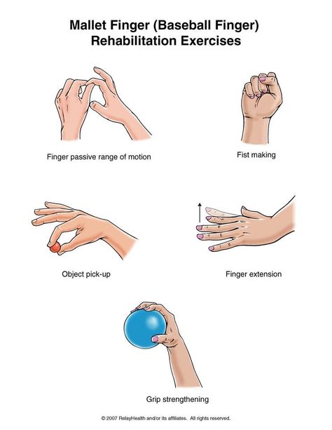 Hand Therapy Exercises, Mallet Finger, Types Of Injuries, Rehabilitation Exercises, Finger Exercises, Physical Therapy Exercises, Hand Exercises, Hand Therapy, Workout Chart