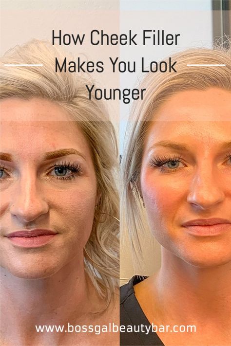 Everyone looks for the fountain of youth. Check out our blog to see our little secret #bossgalbeautybar #medspa #columbusohio #columbusohiomedspa #cheekfiller #youthful Voluma Cheeks, Diy Botox, Sagging Cheeks, Cheek Lift, Cheek Fillers, The Fountain Of Youth, Dark Eye Circles, Facial Aesthetics, Fat Burning Tips