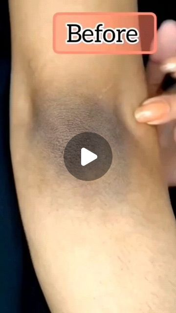 🦋𝓛𝓸𝓿𝓮𝓵𝔂𝓹𝓪𝔂𝓮𝓵 🦋 on Instagram: "✅ Get Rid Dark Elbow 🔥
.
.
.
.
.
.
 #shorts #viral  #skincare #darkness #darkelbows #trending #tanning #instagram #followers #follow #following" Elbow Whitening, Lemon Skincare, Viral Skincare, Dark Elbows, Diy Hack, Hacks Diy, Skin So Soft, Damaged Skin, Tanning