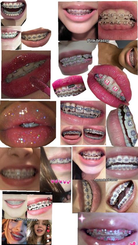 Braces Colors Combinations, Pink Braces, Braces Food, Cute Braces Colors, Teeth Aesthetic, Pretty Teeth, Braces Tips, Grillz Teeth, Getting Braces