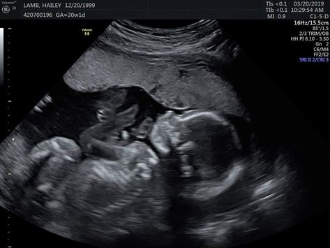 22 Week Ultrasound, 15 Week Ultrasound, 20 Week Ultrasound, Ultrasound Student, 3d Ultrasound Pictures, Twins Ultrasound, Baby Ultrasound Pictures, 2 Months Pregnant, 15 Weeks Pregnant