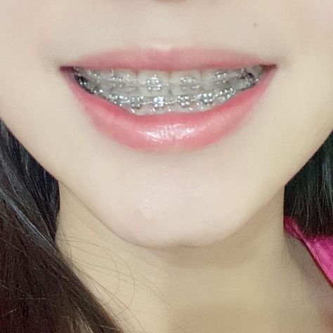 Braces Aesthetic Colors, Braces Aesthetic Girl, Aesthetic Braces, Brackets Aesthetic, Braces Aesthetic, Dental Braces Colors, Pink Braces, Braces Colors Ideas, Braces Food