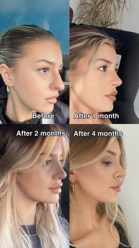 Rhinoplasty Healing Process 🏥✨ Initial Recovery (1-2 weeks) Swelling & bruising are common. Visible Changes (3 months) Most swelling subsides; shape begins to settle. Full Recovery (6-12 months) Final results emerge as swelling completely resolves. Tips for Healing: Follow post-op care instructions 📋 Avoid strenuous activities 🚫💪 Be patient; results take time ⏳ Your new look is worth the wait! 🌟 Rhinoplasty Recovery Tips, Kpop Plastic Surgery, Jaw Reduction Surgery, Rhinoplasty Recovery, V Line Surgery, Plastic Surgery Fail, Korean Plastic Surgery, Plastic Surgery Gone Wrong, Rhinoplasty Before And After