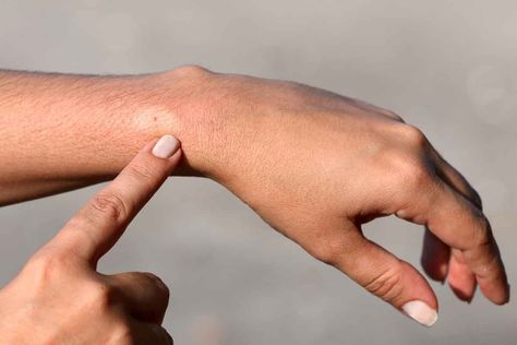 What to Do When a Wasp Stings You Natural Bug Bite Remedy, Treating Bee Stings, Wasp Sting, Bug Bites Remedies, Ant Bites, Wasp Stings, Bed Bug Bites, Natural Bug Repellent, Spider Bites