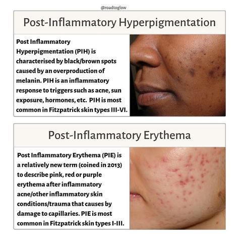 roadtoglow’s Instagram post: “🔍 POST INFLAMMATORY HYPERPIGMENTATION vs POST INFLAMMATORY ERYTHEMA. . 🔍 Post Inflammatory Hyperpigmentation (PIH): PIH is characterised by…” Post Inflammatory Erythema, Hyperpigmentation Remedies, Skin Anatomy, Post Inflammatory Hyperpigmentation, Treating Hyperpigmentation, Acne Overnight, Brown Spots On Face, Spots On Face, Tranexamic Acid