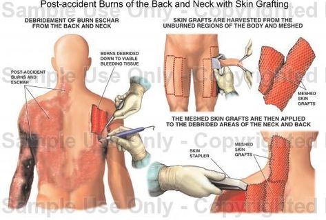 Skin Grafting Skin Grafting, Medical Anatomy, Making Faces, Hearing Loss, Natural History, The Back, Literature, Medical, How To Apply