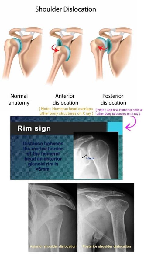 Radiology Schools, Medical Radiography, Hospital Medicine, Radiologic Technology, Shoulder Dislocation, Radiology Student, Radiology Technician, Radiology Imaging, Anatomy Bones