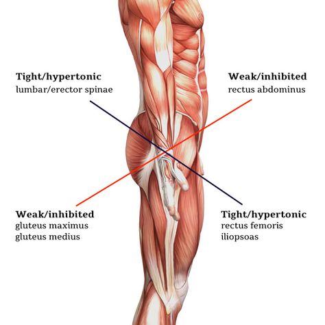 Lower Cross Syndrome, Complex Migraine, Upper Cross Syndrome, Upper Back Pain Exercises, Upper Back Exercises, My Knee Hurts, Yoga Anatomy, Upper Back Pain, Knee Exercises