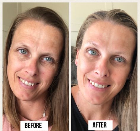 Prp Face Before And After Under Eye, Prp Before And After, Prp Microneedling Before And After, Prp Undereye Before And After, Vampire Facial Before And After, Prp Face Before And After, Microneedling Before And After, Prp Facial, Facial Before And After