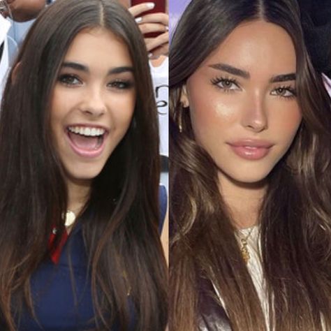 Madison beer plastic surgery Madison Beer Lips Before And After, Madison Beer Before And After Surgery, Madison Beer Plastic Surgery, Maria Core, Madison Beer Outfits, Lip Filler, Celebrities Before And After, After Surgery, Lip Fillers