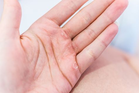 We’ve written recently about how much your fingernails can tell you about your health. But it turns out you can tell a lot from looking at the rest of your hands, too. The NHS says problems with the wrist, hand and fingers are common and can be caused by simple things like carrying out repetitive tasks or an injury during sports or a fall. So, there might not be any need to panic if your hands have become a little sore.But while some problems have obvious causes and are minor, others can be s... Uk Life, Free Homeschool Printables, Trigger Finger, Health Signs, Thyroid Issues, Skin Spots, Flag Signs, Autoimmune Disorder, Shortness Of Breath