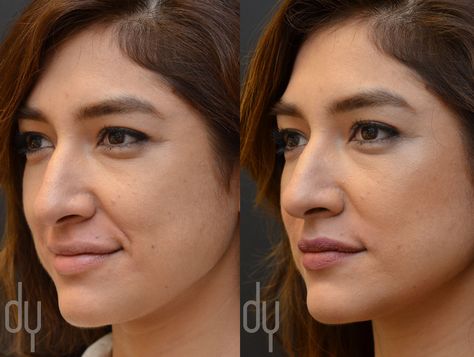 Before and After treating Nasolabial Fold (smile lines) with Juvederm Ultra. Patient desired a softened appearance of her deep smile lines and laugh lines. #smile #smileline #plasticsurgery #filler #drdonyoo Laugh Lines Filler Before And After, Smile Line Fillers Before And After, Botox Before And After, Hair Clinic, Laugh Lines, Smile Lines, Nasolabial Folds, Facial Plastic Surgery, Facial Plastic