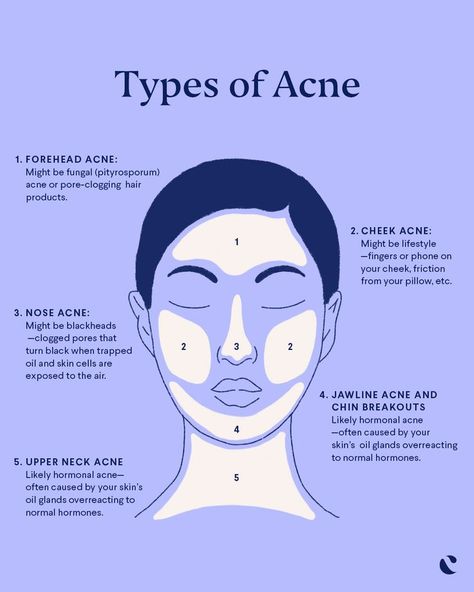 Figuring out what causes acne can be tough, but helping to prevent breakouts just takes a little detective work. Acne face mapping can be key to helping identify the acne cause. While many factors can lead to acne breakouts, the location on your face can be a revealing clue. Click now to find out the meaning behind pimples on your chin, cheeks, jawline and neck. Pimple Face Mapping, Cheek Pimples, Pimple Face, Jawline Acne, Cheek Acne, Neck Acne, Face Map, Chin Acne, Face Mapping Acne