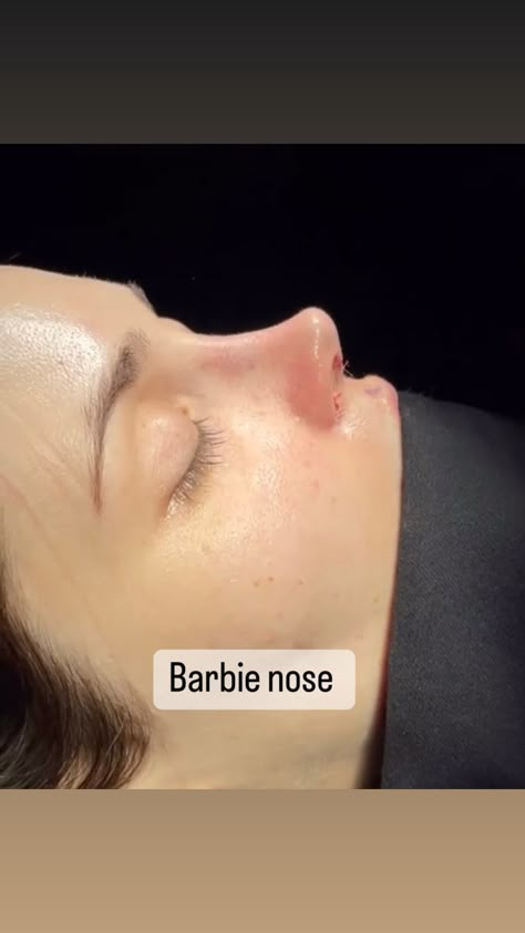 Nose Surgery Aesthetic, Princess Nose Job, Straight Pointy Nose, Tip Plasty Nose, Barbie Nose Job, Nose Job Results, Button Nose Job, Nose Job Inspiration Front View, Turkey Nose Job