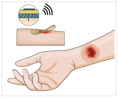 Heal Wounds Faster, Biomedical Engineering, The University Of Arizona, Proof Of Concept, White Blood Cells, Wound Healing, Stanford University, Biotechnology, Band Aid