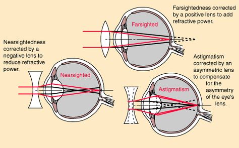 TYPES OF VISION CORRECTION. Eye Retina, Spherical Mirror, Physics Problems, Concave Mirrors, Convex Lens, Lenses Eye, Focus Light, Normal Person, Light Rays