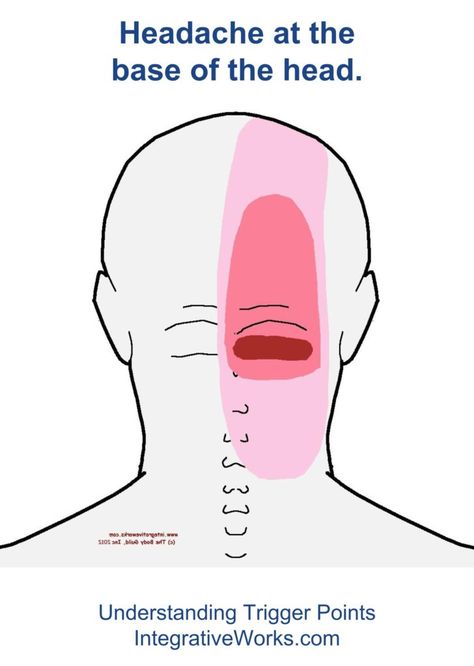 fi-headache-at-the-base-of-the-head-one-side Trigger Points Neck, Stiff Neck Remedies, Sore Shoulder, Headache Relief Instant, Headache Prevention, Essential Oils For Headaches, Natural Headache Remedies, Neck And Shoulder Pain, Migraine Relief