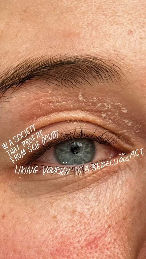 Skin Positive Quotes, Strawberry Freckles, Acne Positivity, Liking Yourself, Sending Positive Vibes, Skin Positivity, Mixed Skin, Trinny London, Beautiful Imperfections