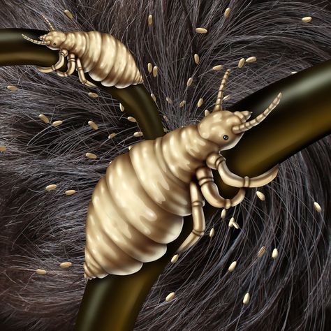 ALL ABOUT THE LICE THAT LIVE IN HAIR Lice In Hair, Lice Pictures, Hair Lice, Lice Eggs, Hair Poster, Lice Removal, Head Louse, Small Insects, Human Head