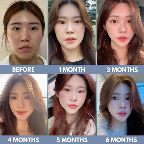 #idhospitalkorea #koreanplasticsurgery #plasticsurgery #plasticsurgerykorea #cosmeticsurgery #seoul #korea #IDtransformation #IDbeforeandafter #plasticsurgerybeforeandafter #beforeandafter #beforeandaftersurgery #besttransformation #vline #vlinesurgery #vshapeface #facialcontouring #cheekbonereduction #ptosiscorrection #eyelidssurgery Cheekbone Reduction, Jaw Reduction Surgery, V Line Surgery, Plastic Surgery Korea, Korean Plastic Surgery, Cotton Suit Designs, V Shape Face, Reduction Surgery, Facial Contouring