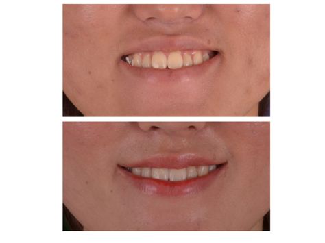 She looked awkward when she smiled before the mouth corner lift. She tried to avoid smiling widely as her gums would become visible. After Smile Lipt, the elasticity on her lips increased due to the raised mouth corners. Therefore, her gums are no longer visible when smiling (or are less visible). Moreover the way she smiles has more composure Liver Care, Aesthetic Clinic, Healthy Teas, Her Smile, Plastic Surgery, To Look, Gum, How To Look Better, The Way