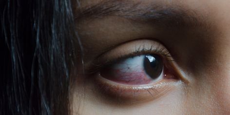 What Exactly Causes Red, Bloodshot Eyes? Eye Examination, Bloodshot Eyes, Eye Infections, Watery Eyes, Light Sensitivity, Eyes Problems, Eye Photography, Etude House, Beauty Hacks Video