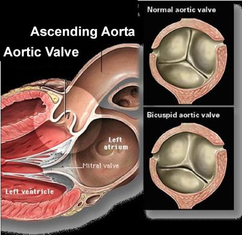 Bicuspid Aortic Valve, Heart Catheterization, Aortic Valve Replacement, Mitral Valve, Brain Surgeon, Heart Sounds, Heart Valves, Carotid Artery, Cardiac Nursing