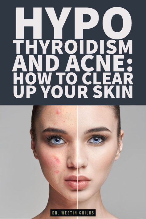 There is a strong connection between hypothyroidism and acne and that is exactly what this article is about. Your thyroid plays a role in the skin such that low thyroid function, hypothyroidism, and Hashimoto's thyroiditis can ALL lead to acne unless treated properly. Even some forms of severe acne can be treated with the right type of thyroid medication or thyroid management. There are also important nutrients that you should be taking if you have thyroid disease which can help clear your ... Acne Pictures, Thyroid Removal, Low Thyroid, Thyroid Symptoms, Hashimotos Disease, Thyroid Medication, Severe Acne, Types Of Acne, Thyroid Function