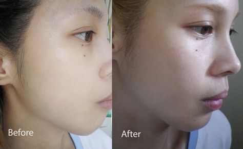 some of glutathione injectable before and after pics. Results are not typical. www.whitechic.net Glutathione Before And After, Before And After Pics, Cleanser For Oily Skin, Beauty Tips For Skin, Dry Skin Care, Skin Care Remedies, Skin Cleanser Products, Daily Skin Care, Skin Issues