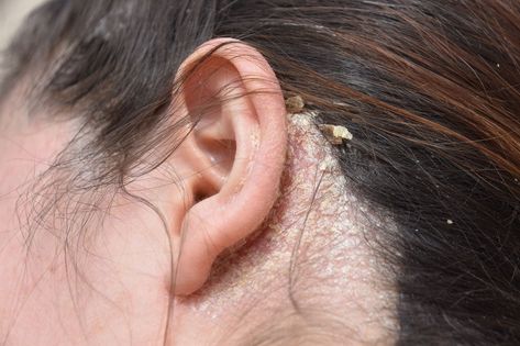 The Sneaky Things Causing Your Scalp to Itch and Flakewomansday Scaly Skin, Itchy Scalp, Sensitive Skin Care, Skin Disorders, Scalp Conditions, Dry Scalp, Dandruff, Skin Treatments, Skin