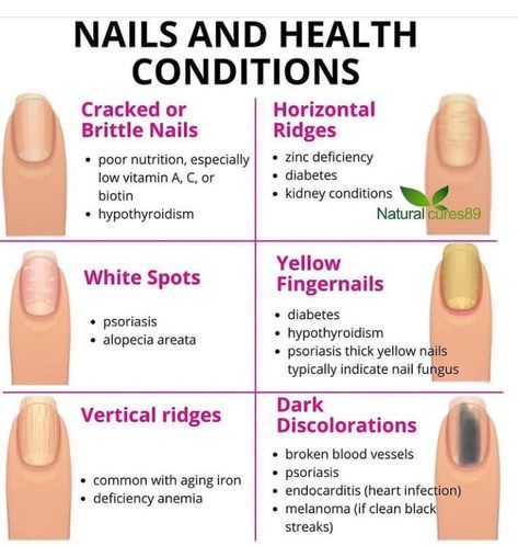 Fingernail Health, Toenail Fungus Remedies, Zinc Deficiency, Basic Anatomy And Physiology, Nail Fungus Remedy, Poor Nutrition, Fungal Nail, Natural Healing Remedies, Home Health Remedies