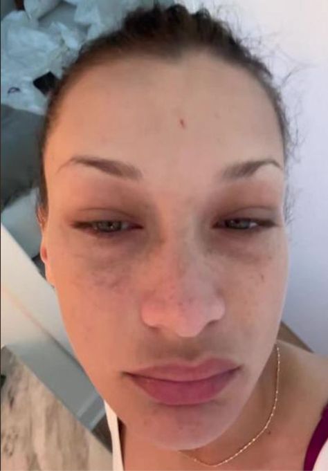 Bella Hadid Palistain, Bella Hadid Supplements, Bella Hadid Before And After Surgery, Bella Hadid Surgery, Bella Hadid Crying, Bella Hadid 2023, Young Bella Hadid, Bella Hadid Face, Bella Hadid Nose