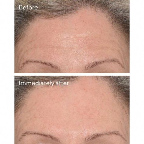 Murad Targeted Wrinkle Corrector instantly reduces the appearance of wrinkles with a Hyaluronic Acid and Peptide enriched formula. Cosmetic Fillers, Retinol Night Cream, Murad Skincare, Wrinkle Filler, Erase Wrinkles, Forehead Wrinkles, Wrinkle Reduction, Bob Hair, Bounce Back