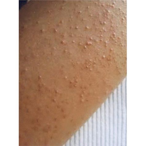 Have you noticed little bumps on the back of your arms or thighs? Keratosis pilaris ( KP) is a common and usually mildskin  condition where small bumps appear on your skin. Its often referred to as chicken skin and can last for a long time.  These tiny bumps are often mistaken for small pimples and are painless. It is most frequently isolated to the back side of the upper arms on the thighs and on the cheeks the bumps can be red white skin-toned or darker than your skin.  Affected skin has a cha Signs Of Gluten Intolerance, Small Pimples, Skin Bumps, Unhealthy Diet, Keratosis Pilaris, Gluten Intolerance, Acne Breakout, Free Life, Sin Gluten