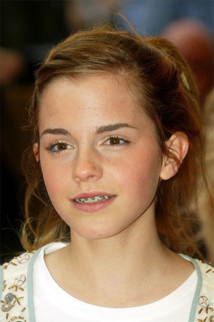 Celebrities With Braces, White Braces, Braces Girls, Cute Braces, Brace Face, Braces Colors, Bailee Madison, Teeth Braces, Faith Hill