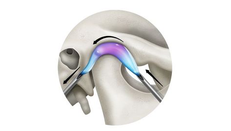 Synovial Fluid, Medical Illustration, Medical, Electronic Products, Medical Illustrations