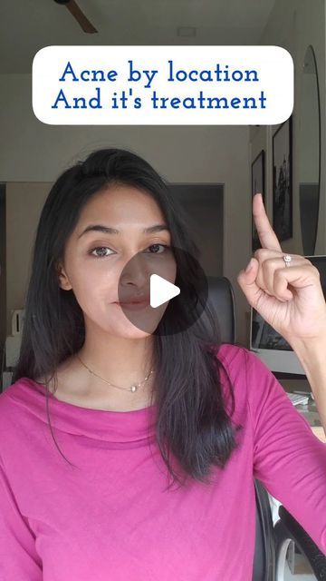 Dr.Nidhi Sawant on Instagram: "Acne can appear in various locations on the body, not just the face. The location of acne can provide insights into potential causes or contributing factors. . Forehead: Causes: Haircare products. Oily scalp. Digestive issues. Types: Whiteheads, blackheads. Use soap which contains ketoconazole and anti-dandruff shampoo. Cheeks: Causes: Dirty pillowcases or phones. Poorly cleaned makeup brushes. Hormonal fluctuations. Types: Whiteheads, blackheads, papules, pustules. Use a clindamycin+ nicotinamide gel or Salicylic acid facewash. Chin and Jawline: Causes: Hormonal fluctuations (common in women). Polycystic Ovary Syndrome (PCOS) in some cases. Types: Hormonal acne, cystic acne. Use benzoyl peroxide cream or Adapalene gel. Back (Back Acne or Bacne): Ca Clindamycin For Acne, Chin Whiteheads, Cheek Acne Cause, Acne On Cheeks, Forehead Acne Cause, Cheek Pimples, Chin Acne Causes, Acne On Nose, Cystic Acne On Chin