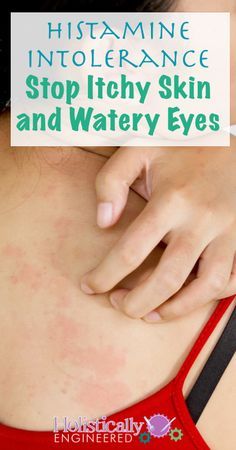 Histamine Intolerance-Stop Itchy Skin and Watery Eyes | holisticallyengineered.com #paleo #lowhistamine #essentialoils Itchy Skin Remedy, Histamine Intolerance, Low Histamine, Watery Eyes, Dry Itchy Skin, Health And Fitness Magazine, Daily Health Tips, Skin Disorders, Dry Sensitive Skin