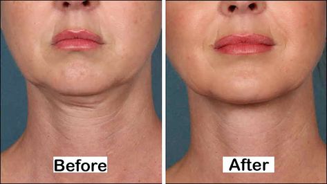 5 Simple Ways To Tighten Your Neck Skin Reduce Face Fat, Obličejové Masky, Reduce Double Chin, Double Menton, Natural Face Lift, Facial Fillers, Face Exercises, Yoga Facial, Facial Exercises