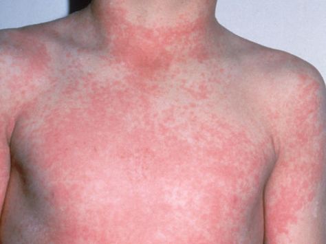 Scarlet fever Fever Rash, Toddler Fever, Throat Infection, Strep Throat, Bacterial Infection, Signs And Symptoms, Skin Conditions, Home Remedies, Scarlet