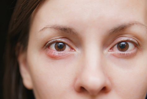 Home remedies for eye infections Stye Remedy, Swollen Eyelid, Sunken Eyes, Top 10 Home Remedies, Eye Infections, Types Of Eyes, Healthy Eyes, Eyes Problems, Best Essential Oils