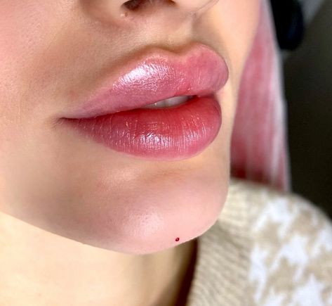 ✅ chin correction done ✅ new lips 👄🔥 How do you like this result? ___________________ Amaks Aesthetics Med Spa 📍1934A Williamsbridge Rd, Bronx, NY For appointments or free consultations, DM or call 🌸 📲 (917) 701-0253 📞 (585)441-3838 #lipfillernewyork #lipfillersnewyork #lipfillernyc #lipinjectionsnyc #lipinjectionsnewyork #lipfillerbronx #lipfillersbronx #lipsinjectionnyc Lip Fillers Inspiration, Lips Fillers, Pouty Lip Filler, Russian Lips Filler, Lip Filler, Face Plastic Surgery, Chin Filler, Lips Inspiration, Facial Fillers