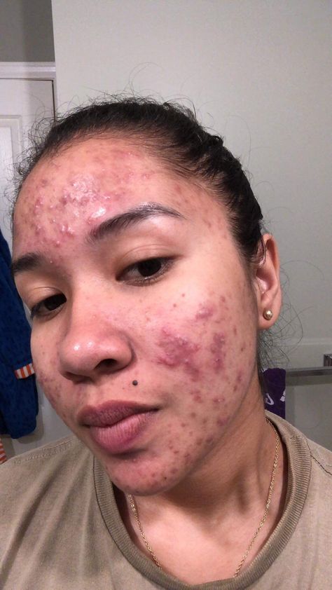 Acne Positive, Acne Pictures, Acne Positivity, Ariana Grande Victorious, Acne Beauty, Love Your Skin, Physical Wellness, The Way You Are, You Are Beautiful