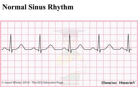 Basic Ekg Rhythms, Heart Rhythms Nursing, Sinoatrial Node, Lethal Rhythms Ekg, Ekg Rhythms, Cardiac Arrhythmias Nursing, Normal Ecg, Sinus Rhythm, Normal Sinus Rhythm