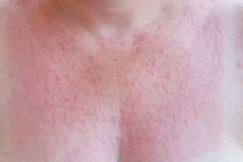 Sun Rash Remedies, Sun Allergy Rash, Gluten Allergy Rash, Heat Rash On Face, Sun Poisoning Rash, Rash On Stomach, Itchy Sunburn, Sun Blisters, Heat Rash Remedy