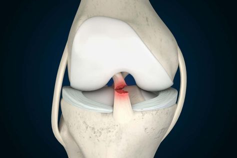 About 30 per cent of tears in the anterior cruciate ligament that supports the knee heal within two years with strengthening exercises, challenging the common assumption that surgery is always needed Anterior Cruciate Ligament, Acl Tear, Ligament Injury, Cruciate Ligament, 9 November, Knee Surgery, Strengthening Exercises, Knee Injury, Science News