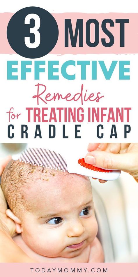 If you notice your baby’s head getting dry and flaky with some yellow crusty patches, it could mean that he/she is suffering from cradle cap or infantile seborrheic dermatitis.   This condition is quite common among babies, but it is also harmless so no need to worry.   Wondering how to get rid of cradle cap? Here’s what you need to know about its causes and remedies. Baby Dry Scalp, Cradle Cap Remedies, Baby Cradle Cap, Infant Care, Newborn Baby Care, Cradle Cap, Baby Cradle, Baby Tips, Mom Bloggers