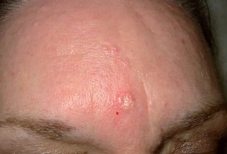 Pictures of Skin Diseases and Problems - Less Common Skin Cancers Skin Disease Pictures, Sebaceous Hyperplasia, Face Skin Problems, Hiit Workouts For Men, Basal Cell, Hiit Workouts, Skin Diseases, Health Matters, Hiit Workout