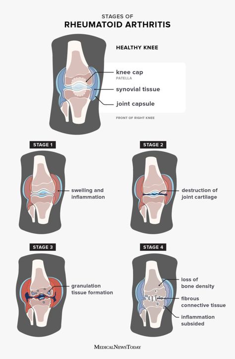 Rheumatoid arthritis in knees: Pictures, symptoms, and more Stretches For Knee Pain, Rheumatoid Nodules, Pathology Study, Knee Pain Remedies, Knee Inflammation, Sick Of Being Sick, Vitamins For Nerves, Ra Symptoms, Medical Infographic